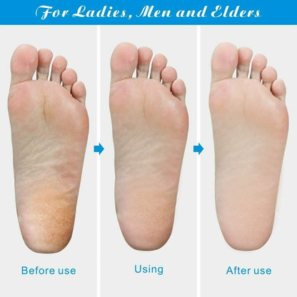 Professional Foot Callus Remover – Pedicure Tool for Cracked & Rough Skin